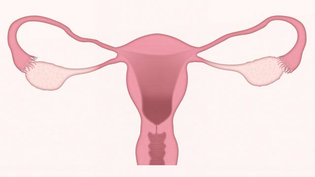 hysterectomy- صورة المقال